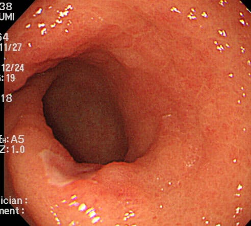良性の胃潰瘍に見えた前庭部の早期癌1