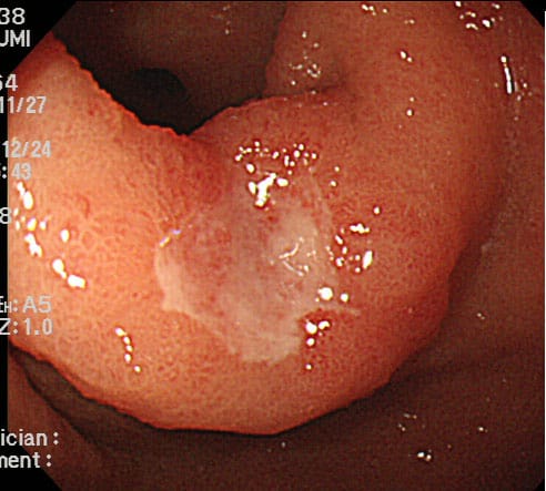 良性の胃潰瘍に見えた前庭部の早期癌2
