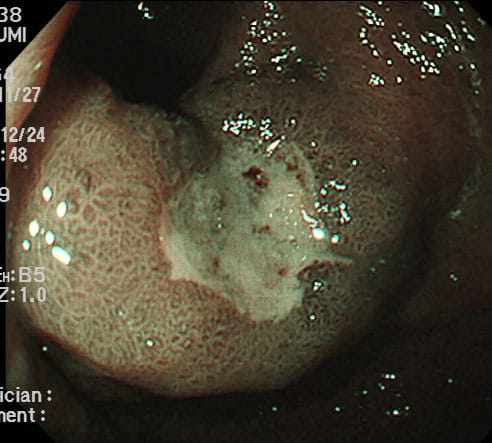 良性の胃潰瘍に見えた前庭部の早期癌3