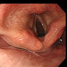 咽頭の早期癌および食道に多発癌1