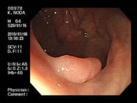 横行結腸の茎のない10mm前後のポリープです。