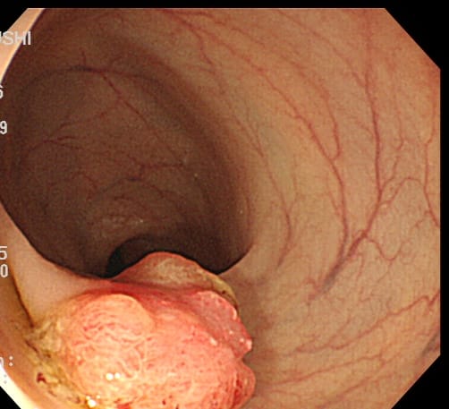 結腸早期がん1