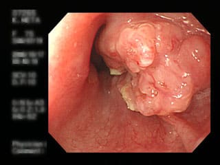 症例4.　75歳男性：「数日前から食物が喉に引っかかるようになり」胃内視鏡検査目的で来院